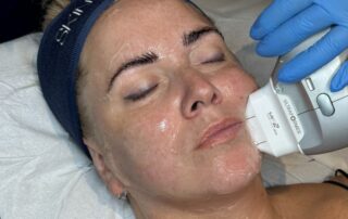 Client receiving a HIFU Ultraformer III Non-Surgical Face Lift at SKIN lounge Aesthetics Richmond Hill, using focused ultrasound technology to lift, firm, and contour the face for a youthful, rejuvenated appearance without surgery or downtime.