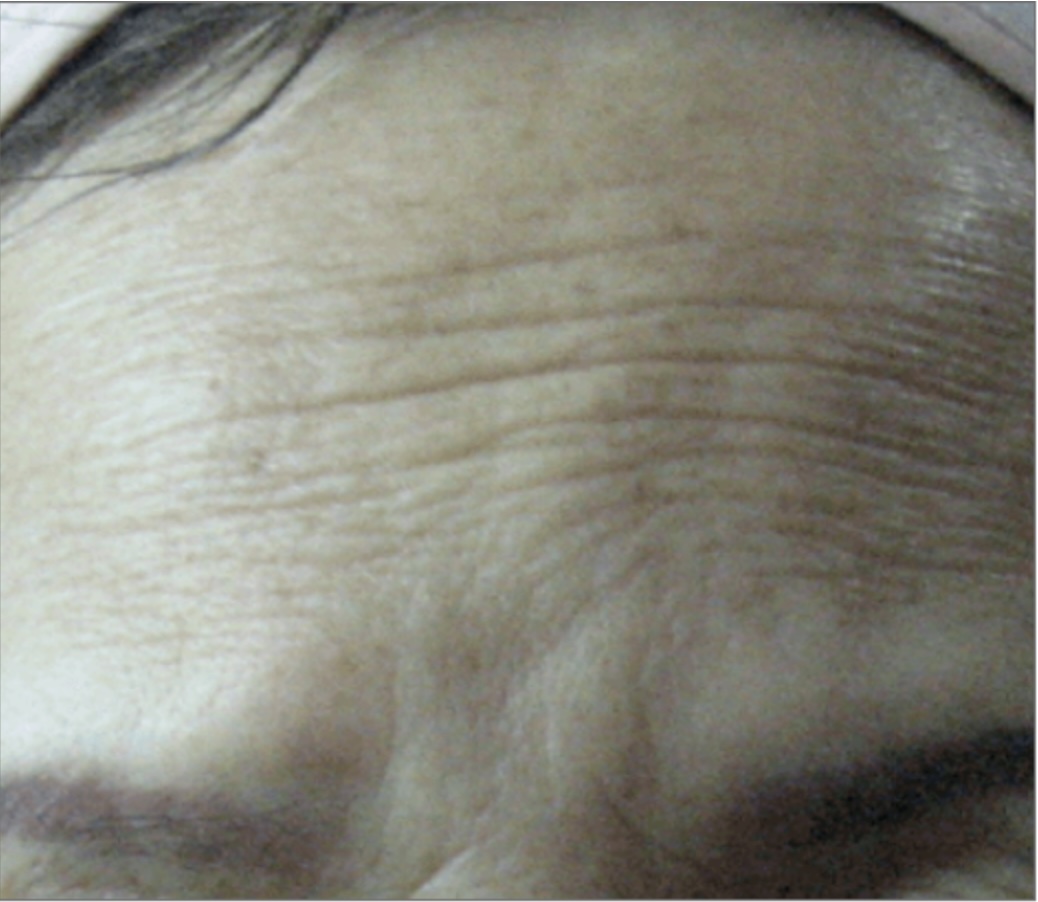 Client receiving a HIFU Ultraformer III Non-Surgical Face Lift at SKIN lounge Aesthetics Richmond Hill, using focused ultrasound technology to lift, firm, and contour the face for a youthful, rejuvenated appearance without surgery or downtime.