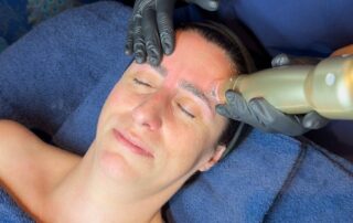 Client receiving Sylfirm X RF Microneedling with ASCE Rose Exosomes at SKIN lounge Aesthetics Richmond Hill, combining radiofrequency energy and regenerative exosome technology to smooth fine lines, tighten skin, and enhance overall radiance and texture.