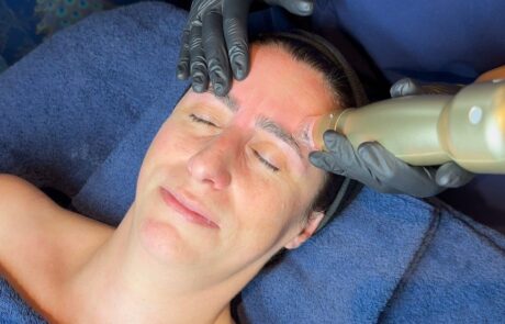 Client receiving Sylfirm X RF Microneedling with ASCE Rose Exosomes at SKIN lounge Aesthetics Richmond Hill, combining radiofrequency energy and regenerative exosome technology to smooth fine lines, tighten skin, and enhance overall radiance and texture.