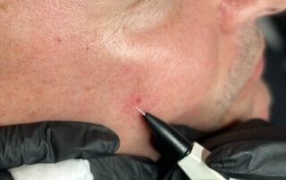 Client receiving Sterex electrolysis blemish removal treatment at SKIN lounge Aesthetics Richmond, using precision electrical currents to safely remove skin tags, thread veins, and other minor blemishes.