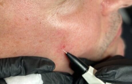 Client receiving Sterex electrolysis blemish removal treatment at SKIN lounge Aesthetics Richmond, using precision electrical currents to safely remove skin tags, thread veins, and other minor blemishes.