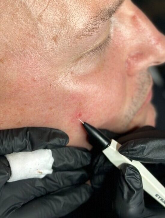 Client receiving Sterex electrolysis blemish removal treatment at SKIN lounge Aesthetics Richmond, using precision electrical currents to safely remove skin tags, thread veins, and other minor blemishes.