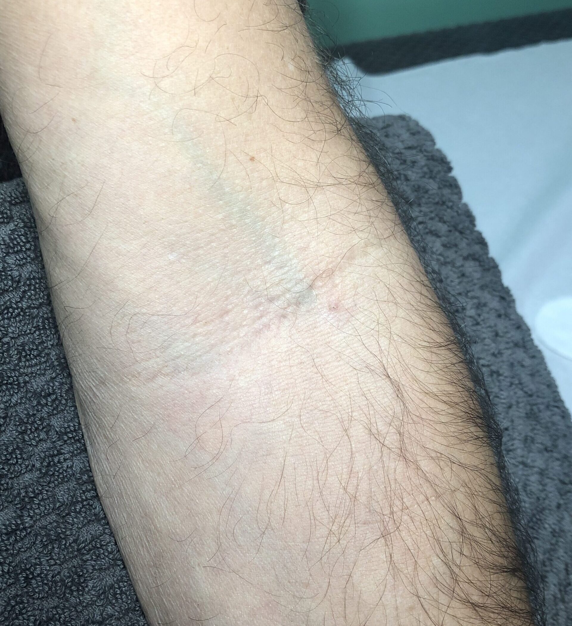 Client receiving Sterex electrolysis blemish removal treatment at SKIN lounge Aesthetics Richmond, using precision electrical currents to safely remove skin tags, thread veins, and other minor blemishes.