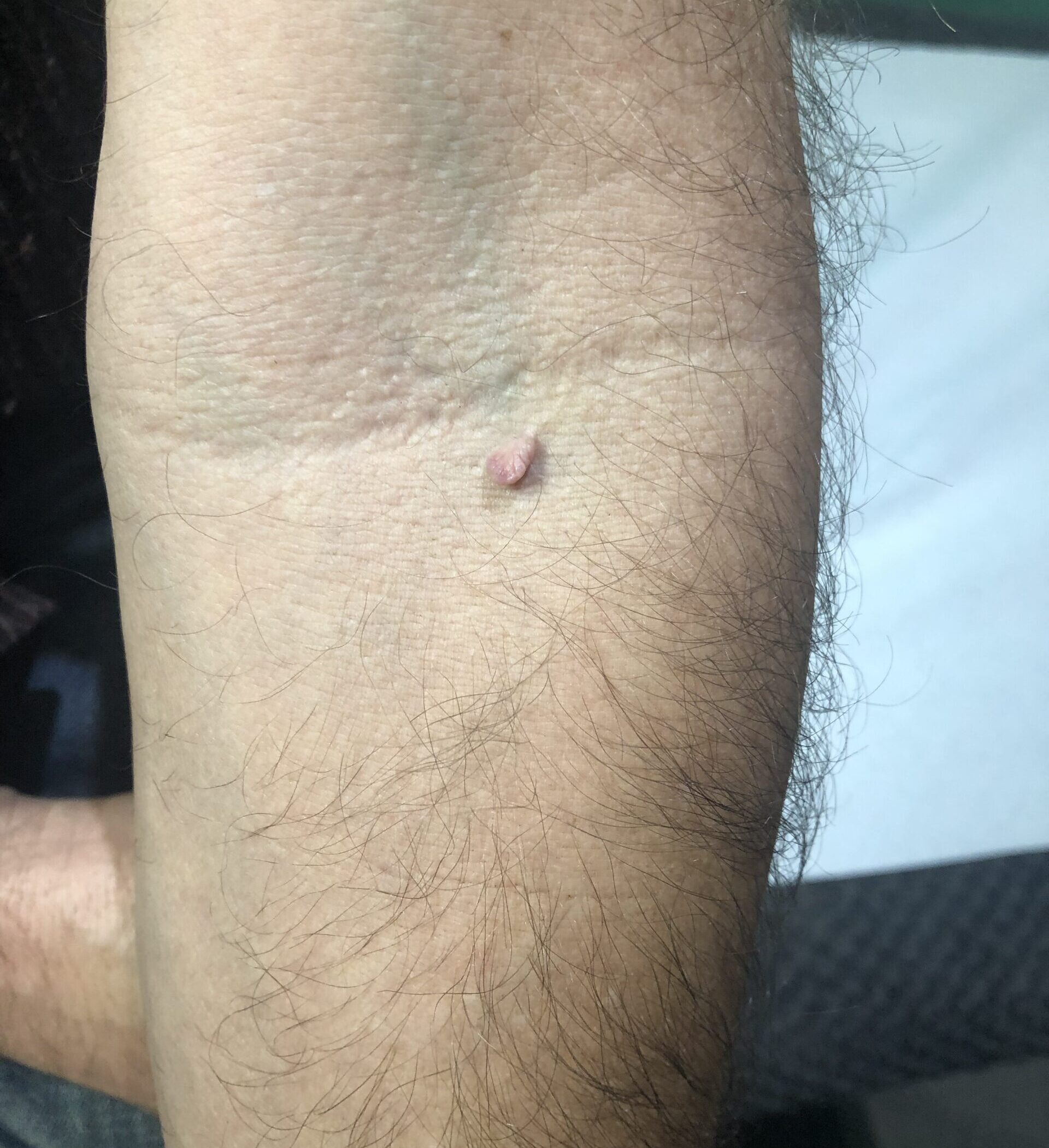 Client receiving Sterex electrolysis blemish removal treatment at SKIN lounge Aesthetics Richmond, using precision electrical currents to safely remove skin tags, thread veins, and other minor blemishes.