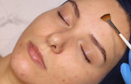 Client receiving a Bespoke AlumierMD Peel at SKIN lounge Aesthetics Richmond, a customised chemical peel treatment that gently exfoliates and rejuvenates the skin for a glowing, even-toned finish.