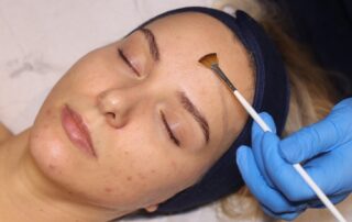 Client receiving a Bespoke AlumierMD Peel at SKIN lounge Aesthetics Richmond, a customised chemical peel treatment that gently exfoliates and rejuvenates the skin for a glowing, even-toned finish.