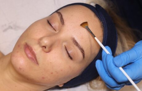 Client receiving a Bespoke AlumierMD Peel at SKIN lounge Aesthetics Richmond, a customised chemical peel treatment that gently exfoliates and rejuvenates the skin for a glowing, even-toned finish.