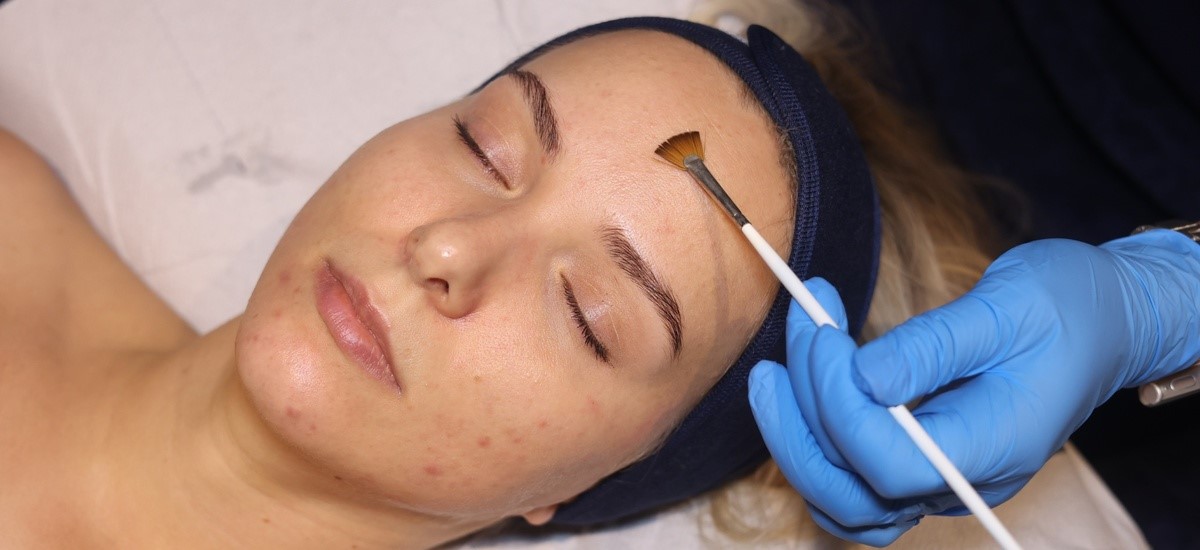 Client receiving a Bespoke AlumierMD Peel at SKIN lounge Aesthetics Richmond, a customised chemical peel treatment that gently exfoliates and rejuvenates the skin for a glowing, even-toned finish.