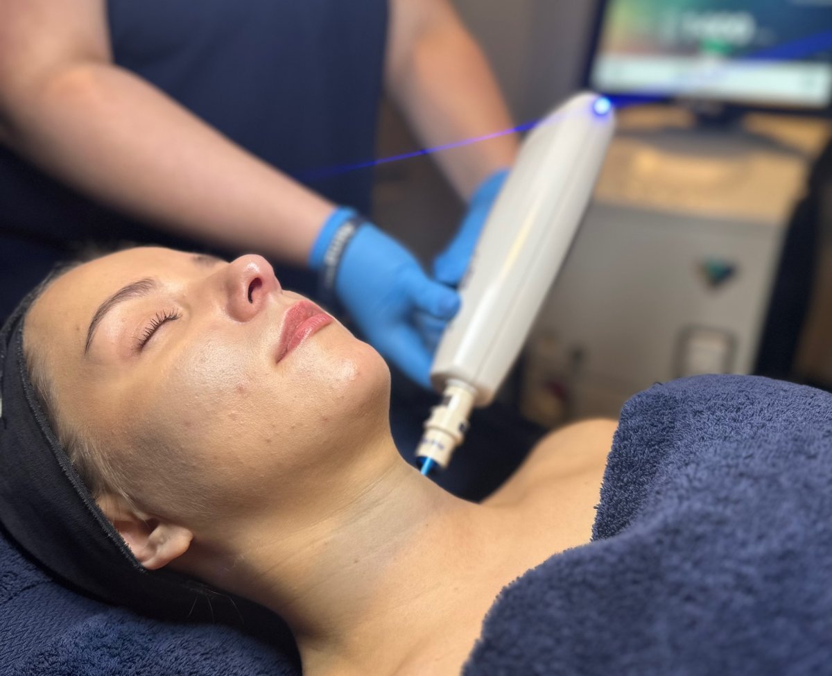 Client receiving Harmony XL PRO ClearLift treatment at SKIN lounge Aesthetics Richmond, using advanced fractional laser technology to lift, tone, and revitalise the skin without downtime.