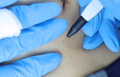 Client receiving Sterex electrolysis hair removal at SKIN lounge Aesthetics Richmond, using a precise electrical current to permanently remove unwanted hair safely and effectively.