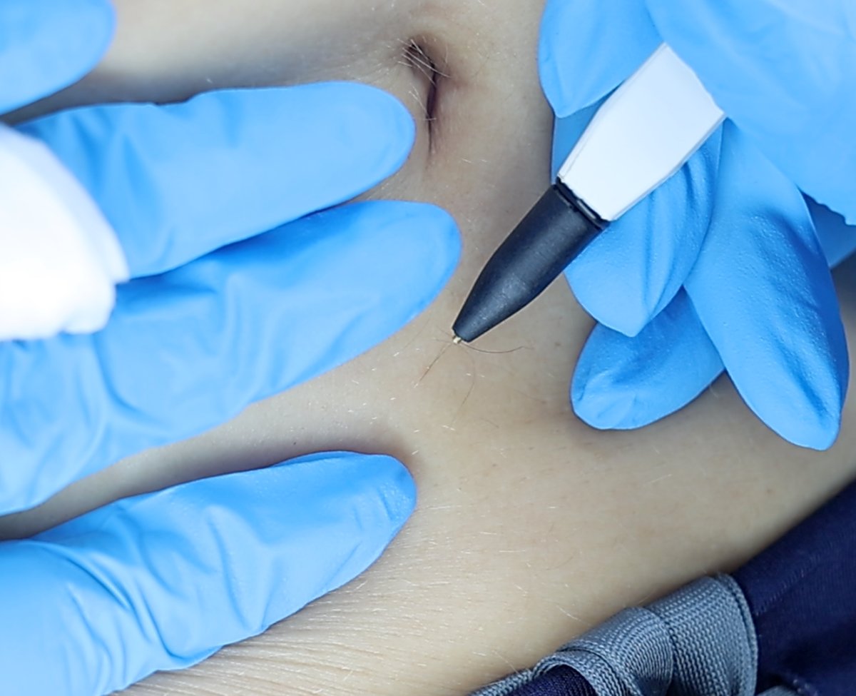 Client receiving Sterex electrolysis hair removal at SKIN lounge Aesthetics Richmond, using a precise electrical current to permanently remove unwanted hair safely and effectively.