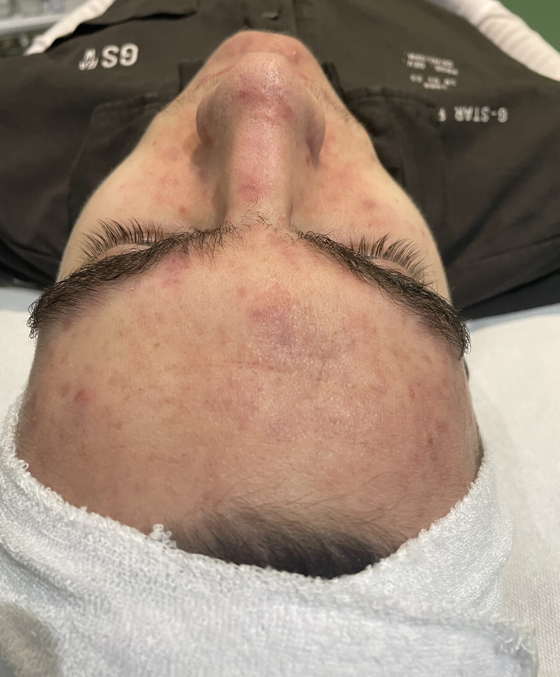 Client enjoying a HydraClean deep-cleansing facial at SKIN lounge Aesthetics Richmond Hill, an expert treatment combining professional techniques and targeted skincare to deeply cleanse, purify, and reduce acne, congestion, and scarring.