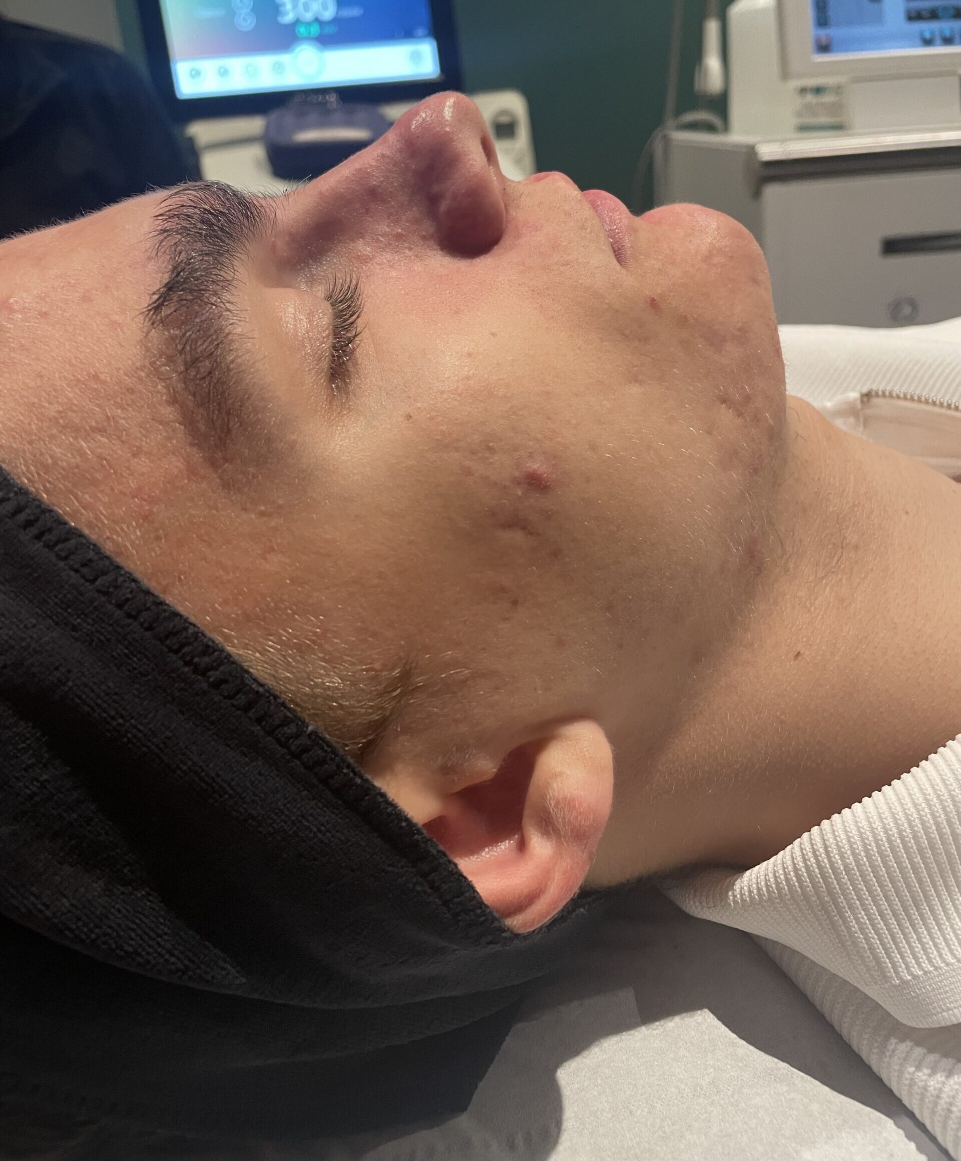 Client enjoying a HydraClean deep-cleansing facial at SKIN lounge Aesthetics Richmond Hill, an expert treatment combining professional techniques and targeted skincare to deeply cleanse, purify, and reduce acne, congestion, and scarring.