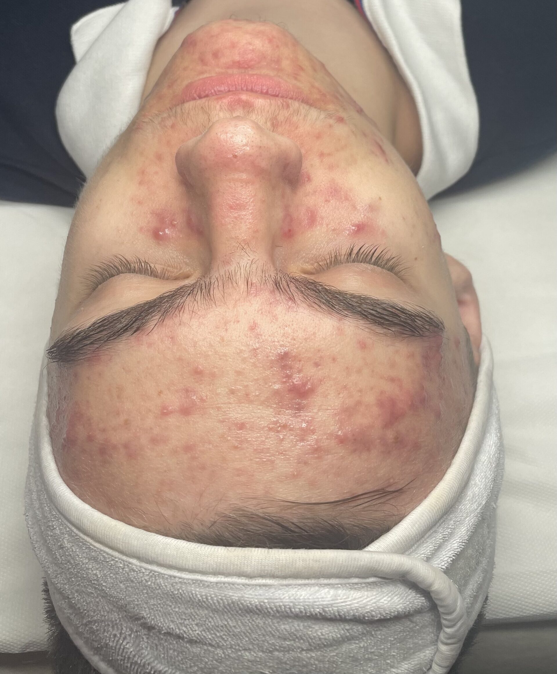 Client enjoying a HydraClean deep-cleansing facial at SKIN lounge Aesthetics Richmond Hill, an expert treatment combining professional techniques and targeted skincare to deeply cleanse, purify, and reduce acne, congestion, and scarring.