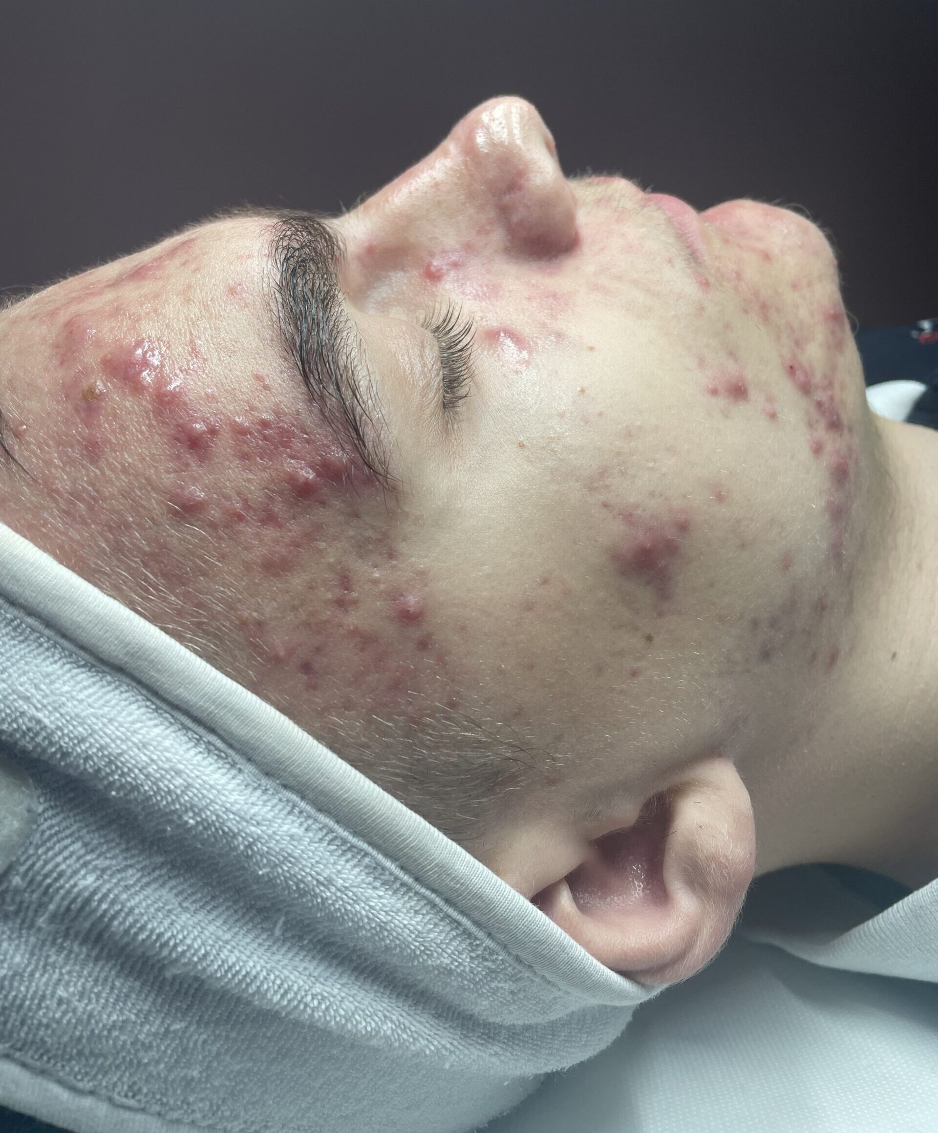 Client enjoying a HydraClean deep-cleansing facial at SKIN lounge Aesthetics Richmond Hill, an expert treatment combining professional techniques and targeted skincare to deeply cleanse, purify, and reduce acne, congestion, and scarring.