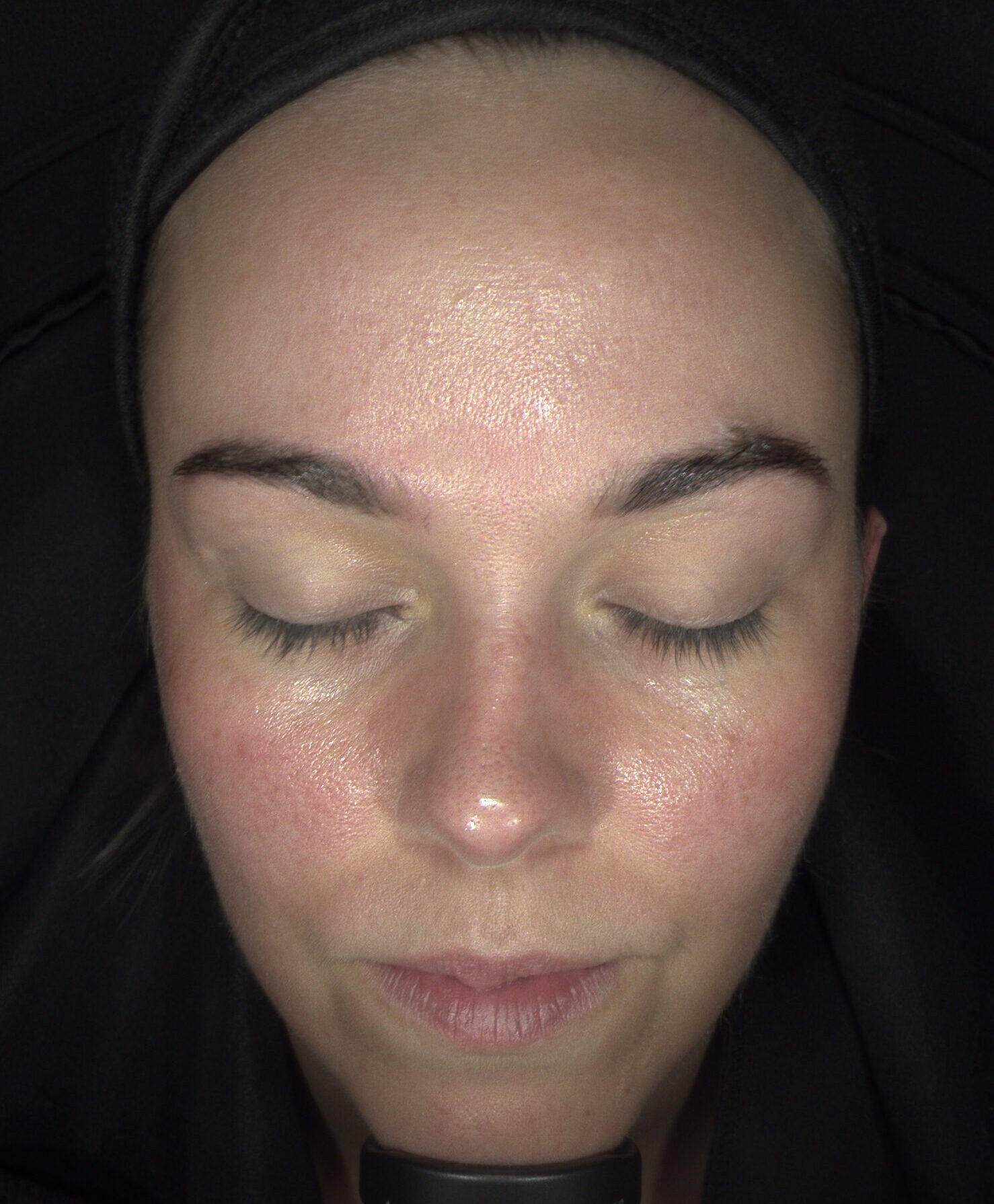 Client enjoying a HydraRefresh facial at SKIN lounge Aesthetics Richmond Hill, a cutting-edge treatment combining deep cleansing, exfoliation, and hydration technology to rejuvenate the skin, boost collagen, and enhance natural radiance.