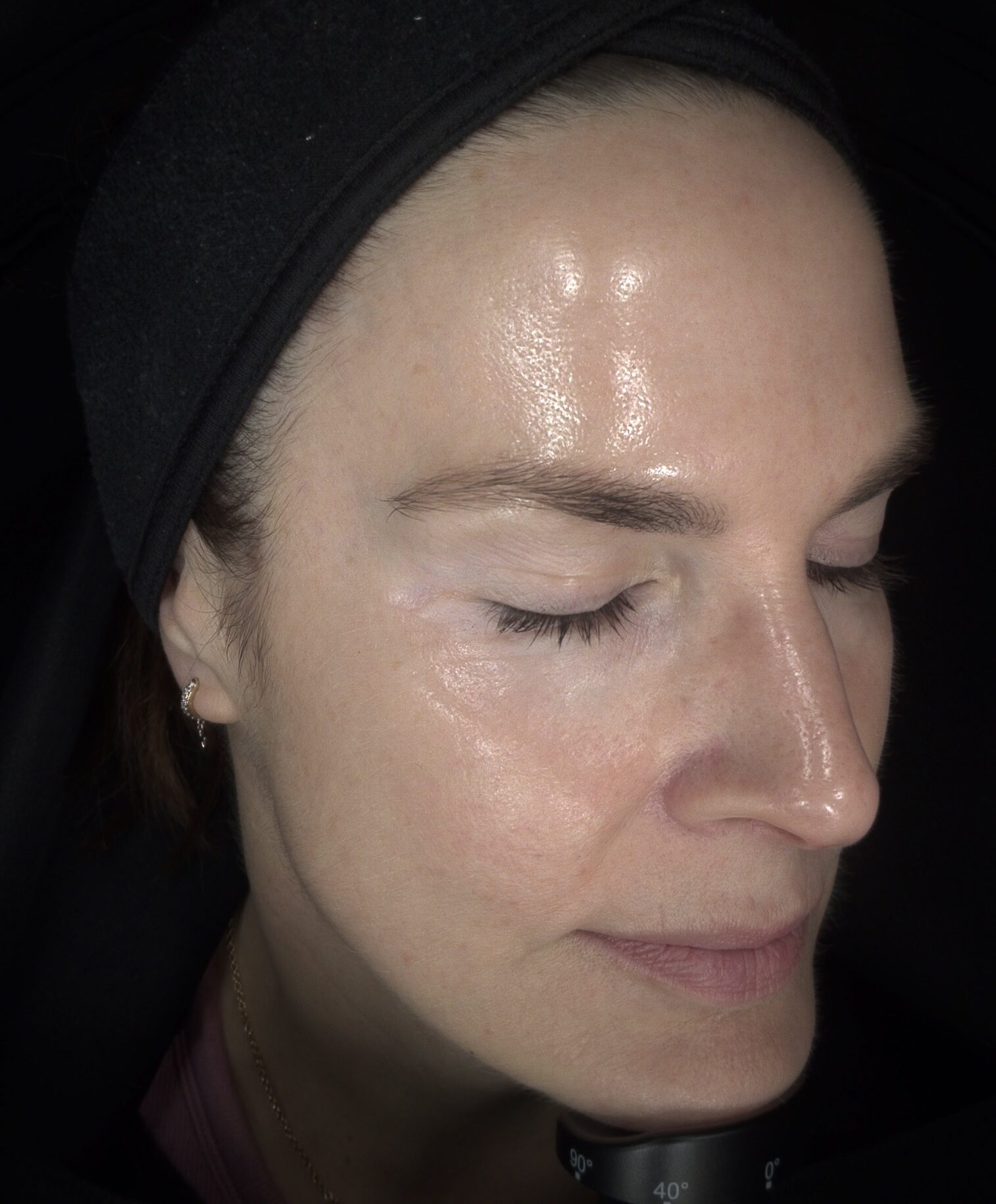 Client skin after iPixel Laser Resurfacing