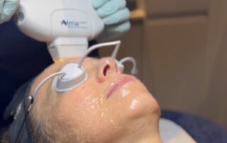 Client receiving Harmony XL PRO IPL Skin Rejuvenation at SKIN lounge Aesthetics Richmond, using advanced light technology to improve skin texture, reduce pigmentation, and enhance overall radiance.