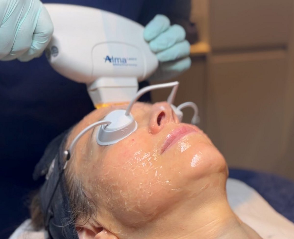 Client receiving Harmony XL PRO IPL Skin Rejuvenation at SKIN lounge Aesthetics Richmond, using advanced light technology to improve skin texture, reduce pigmentation, and enhance overall radiance.