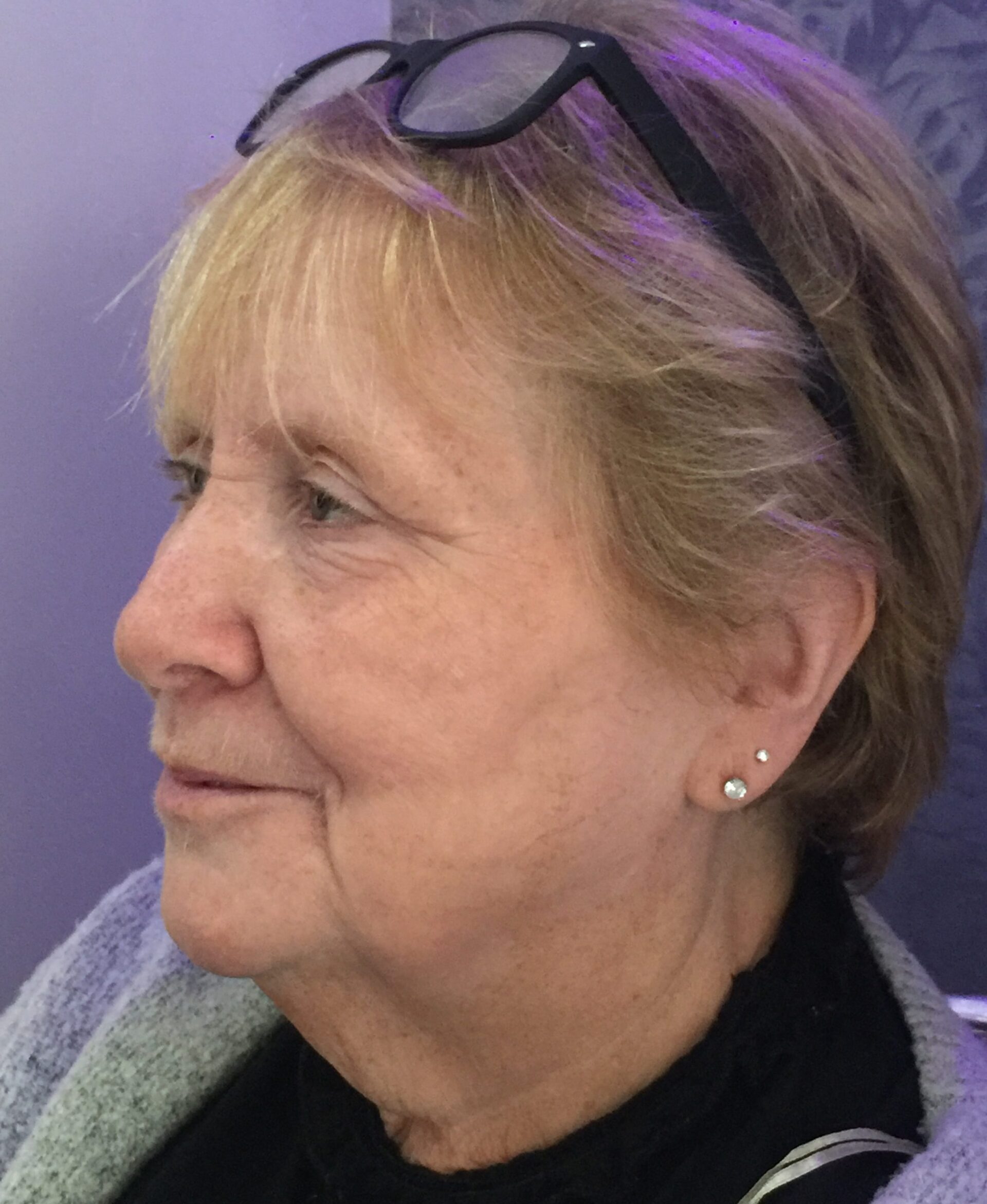 Client receiving Harmony XL PRO IPL Skin Rejuvenation at SKIN lounge Aesthetics Richmond, using advanced light technology to improve skin texture, reduce pigmentation, and enhance overall radiance.