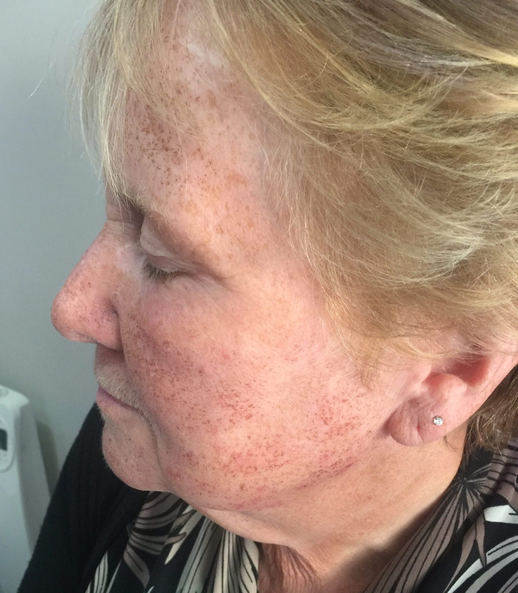 Client receiving Harmony XL PRO IPL Skin Rejuvenation at SKIN lounge Aesthetics Richmond, using advanced light technology to improve skin texture, reduce pigmentation, and enhance overall radiance.