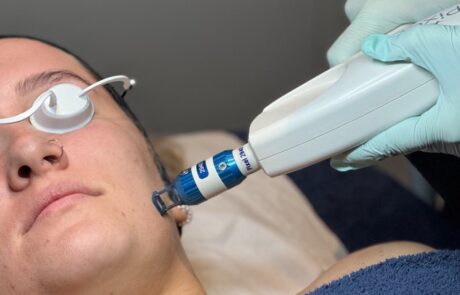 Client receiving Harmony XL PRO iPixel laser resurfacing treatment at SKIN lounge Aesthetics Richmond, targeting fine lines, sun damage, and uneven skin texture for a smoother, radiant complexion.