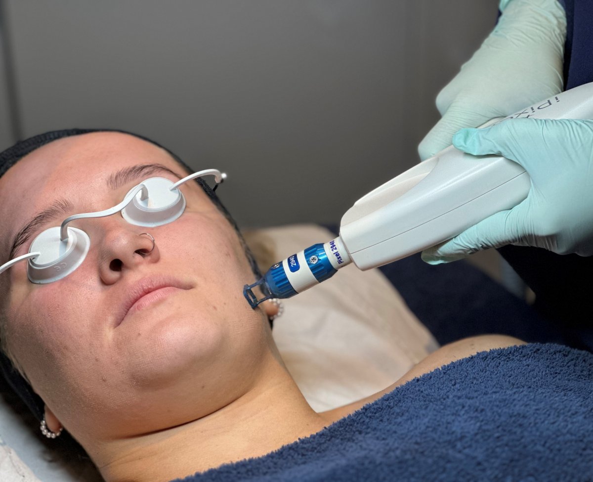 Client receiving Harmony XL PRO iPixel laser resurfacing treatment at SKIN lounge Aesthetics Richmond, targeting fine lines, sun damage, and uneven skin texture for a smoother, radiant complexion.