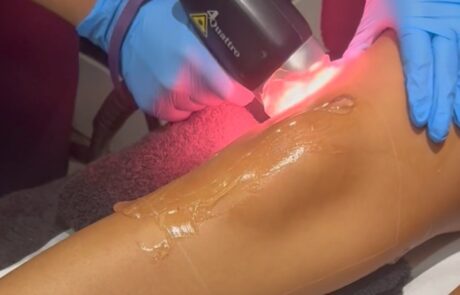 Client receiving Soprano Titanium laser hair removal at SKIN lounge Aesthetics Richmond, using advanced technology for safe, comfortable, and effective hair reduction.