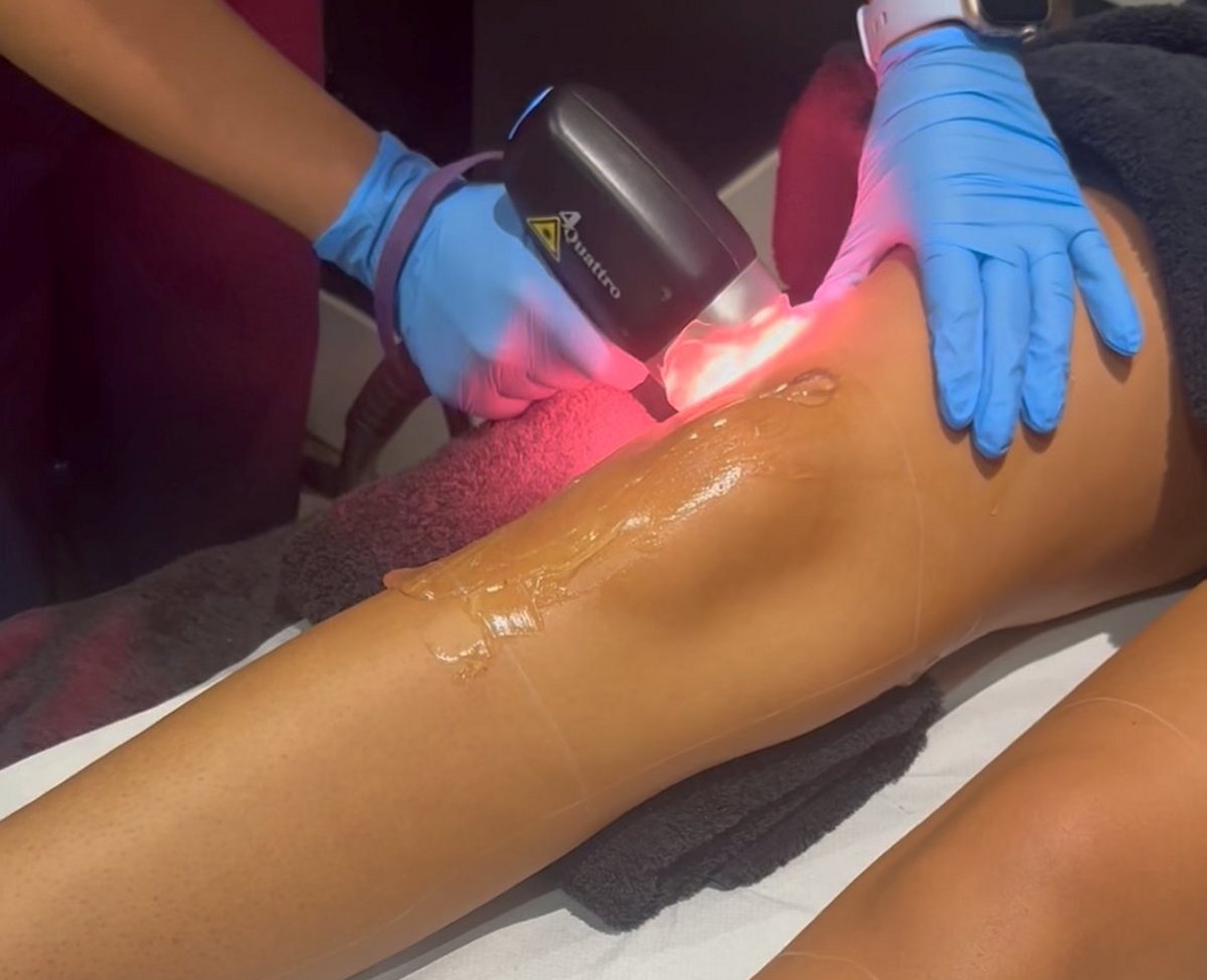 Client receiving Soprano Titanium laser hair removal at SKIN lounge Aesthetics Richmond, using advanced technology for safe, comfortable, and effective hair reduction.