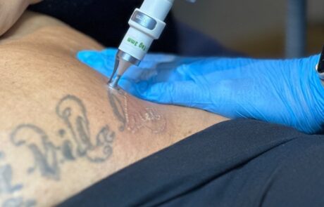 Client receiving laser tattoo removal at SKIN lounge Aesthetics Richmond, using advanced laser technology to safely reduce and remove unwanted ink.