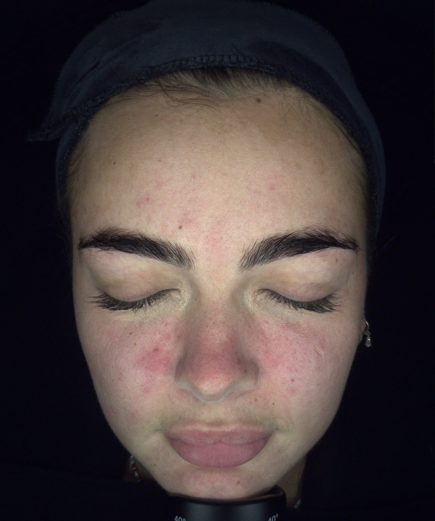 clients skin 2 months before regular treatments of Harmony XL ClearLift Laser