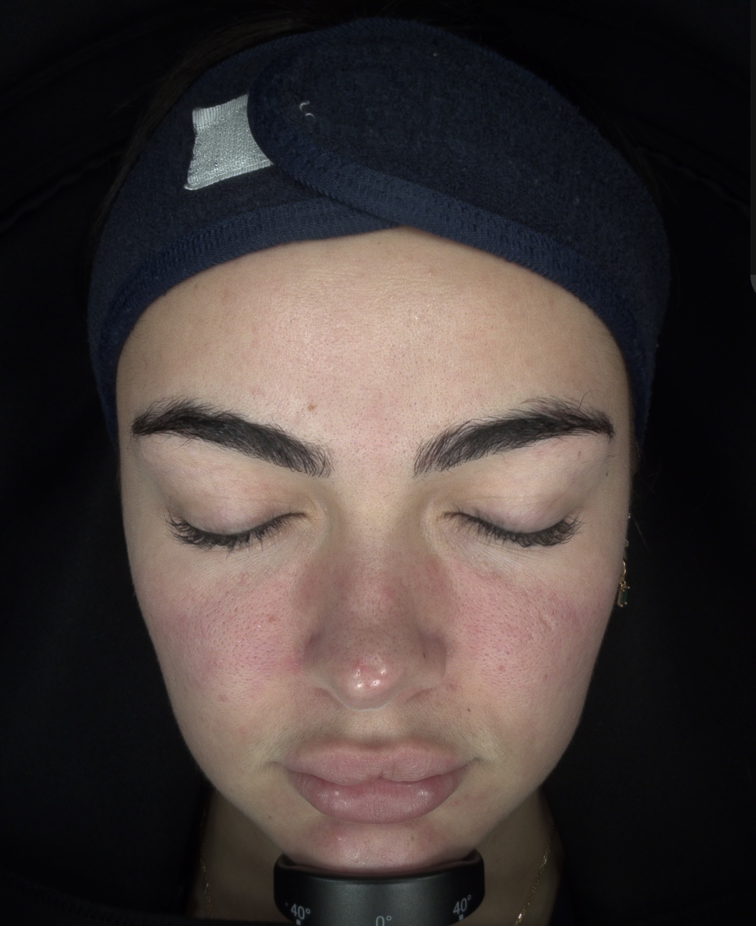 clients skin after 2 months of regular treatments of Harmony XL ClearLift Laser