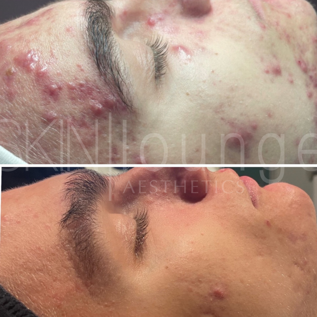 Client at SKIN lounge Aesthetics before and after, acne prone skin