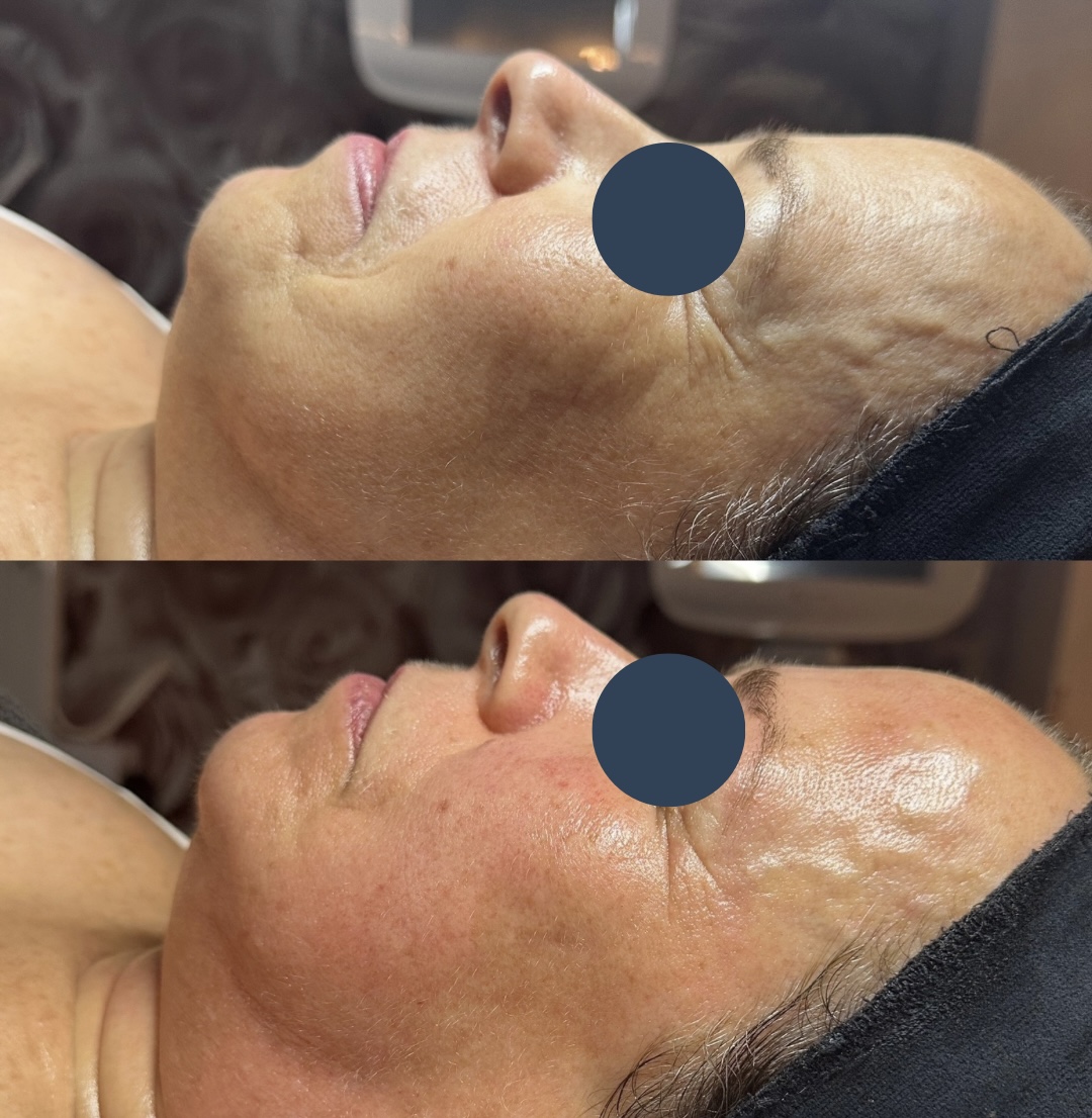 Client at SKIN lounge Aesthetics before and after a HydraLift Deluxe treatment
