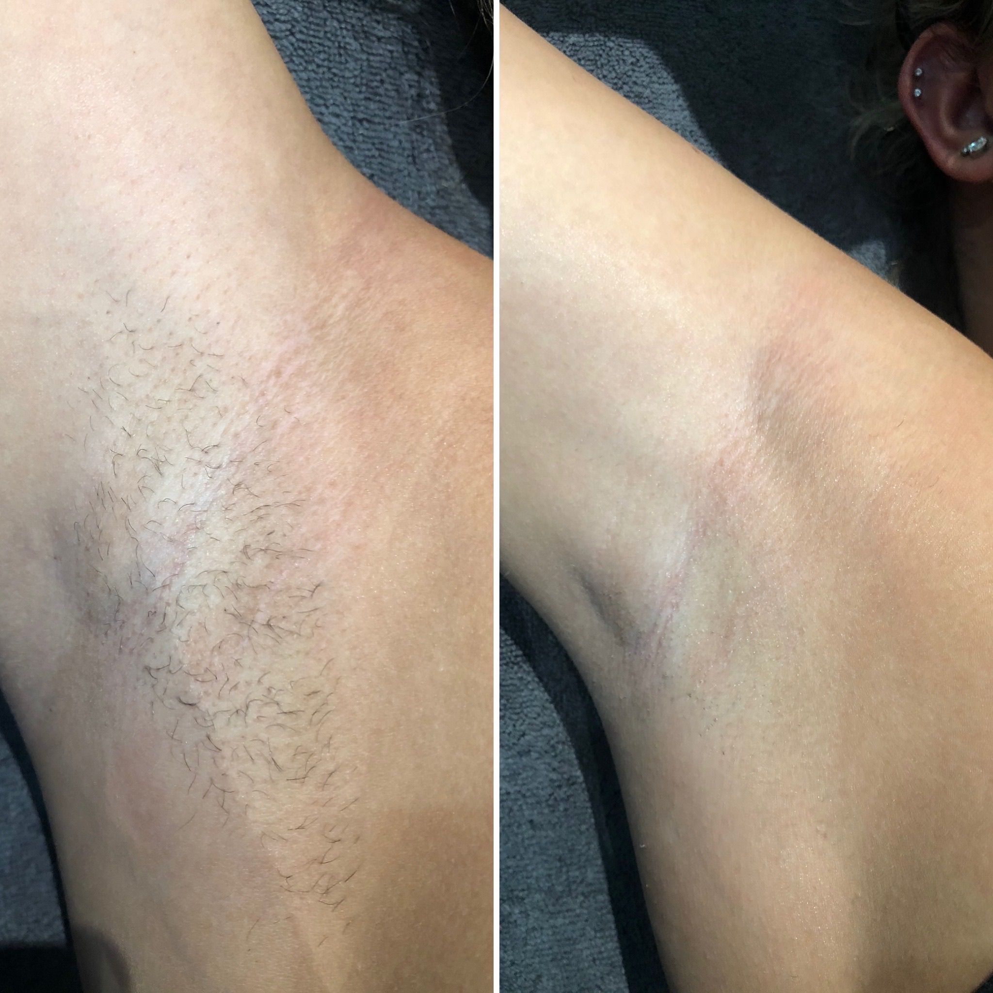 client before and after at SKIN lounge Aesthetics for laser hair removal
