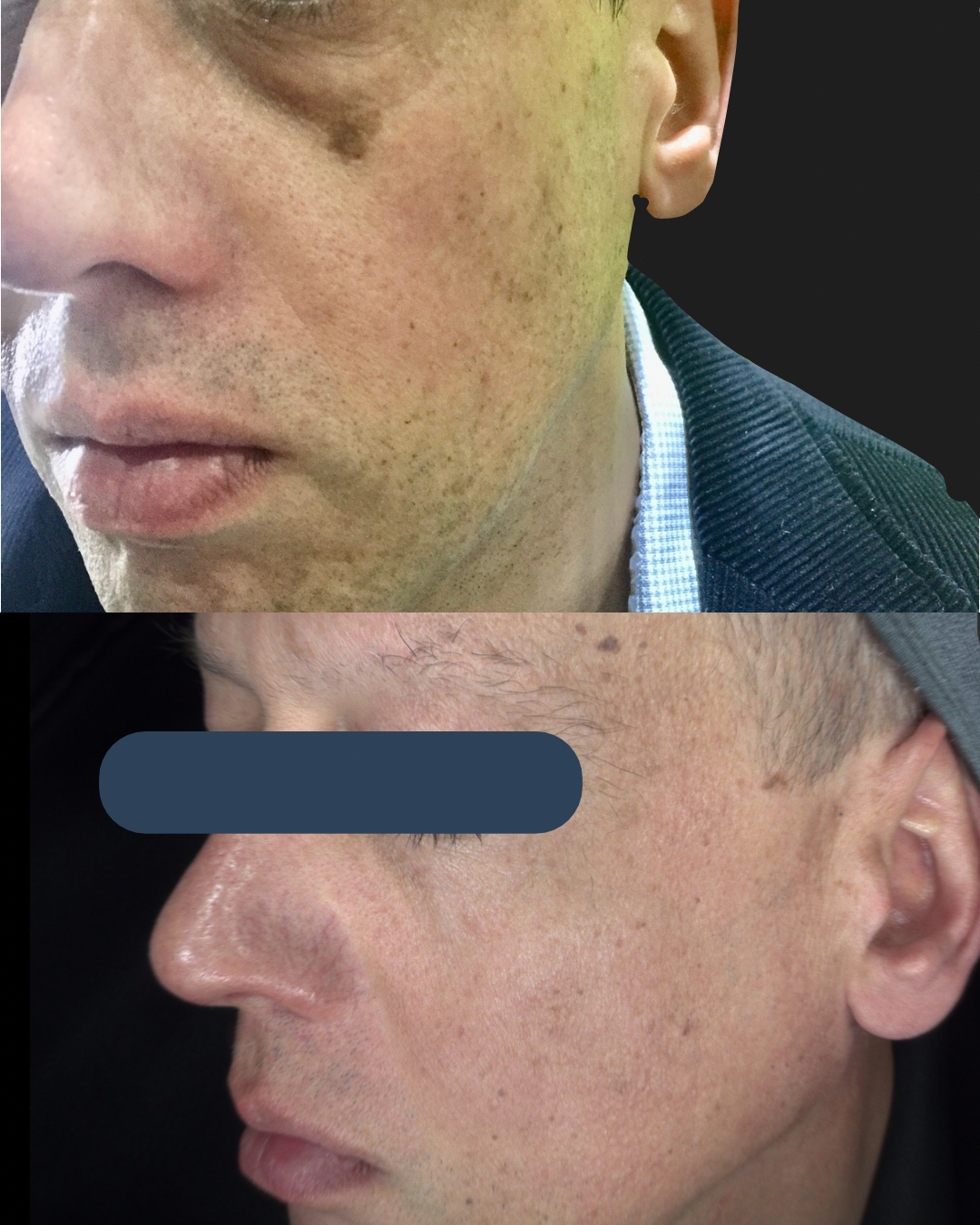 pigmentation before and after