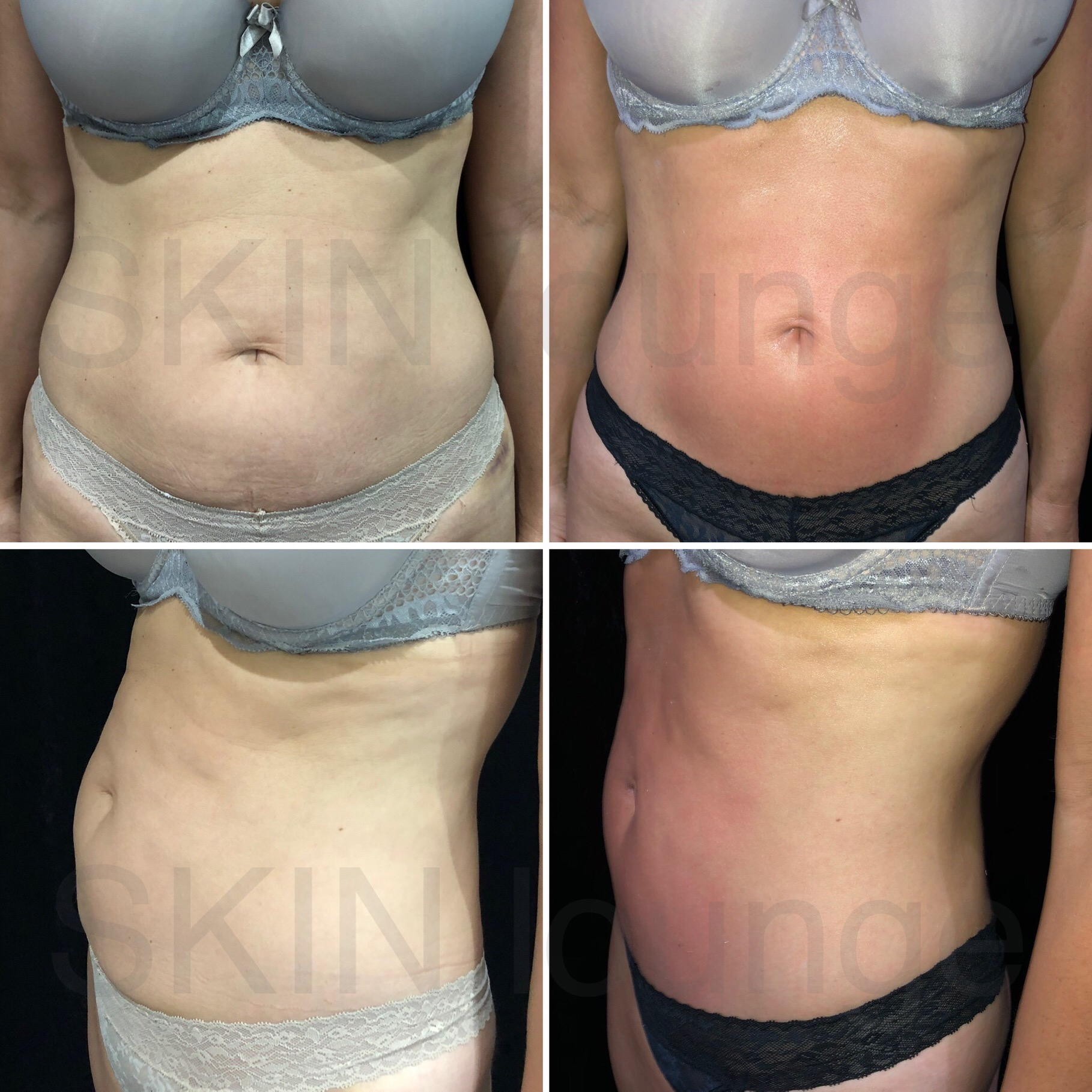 T-Shape Body Resculpting at SKIN lounge Aesthetics Richmond