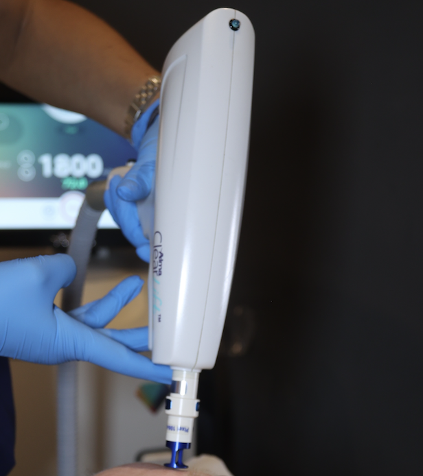 laser tattoo removal