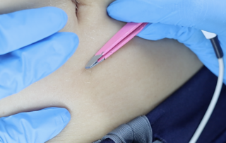 electrolysis hair removal