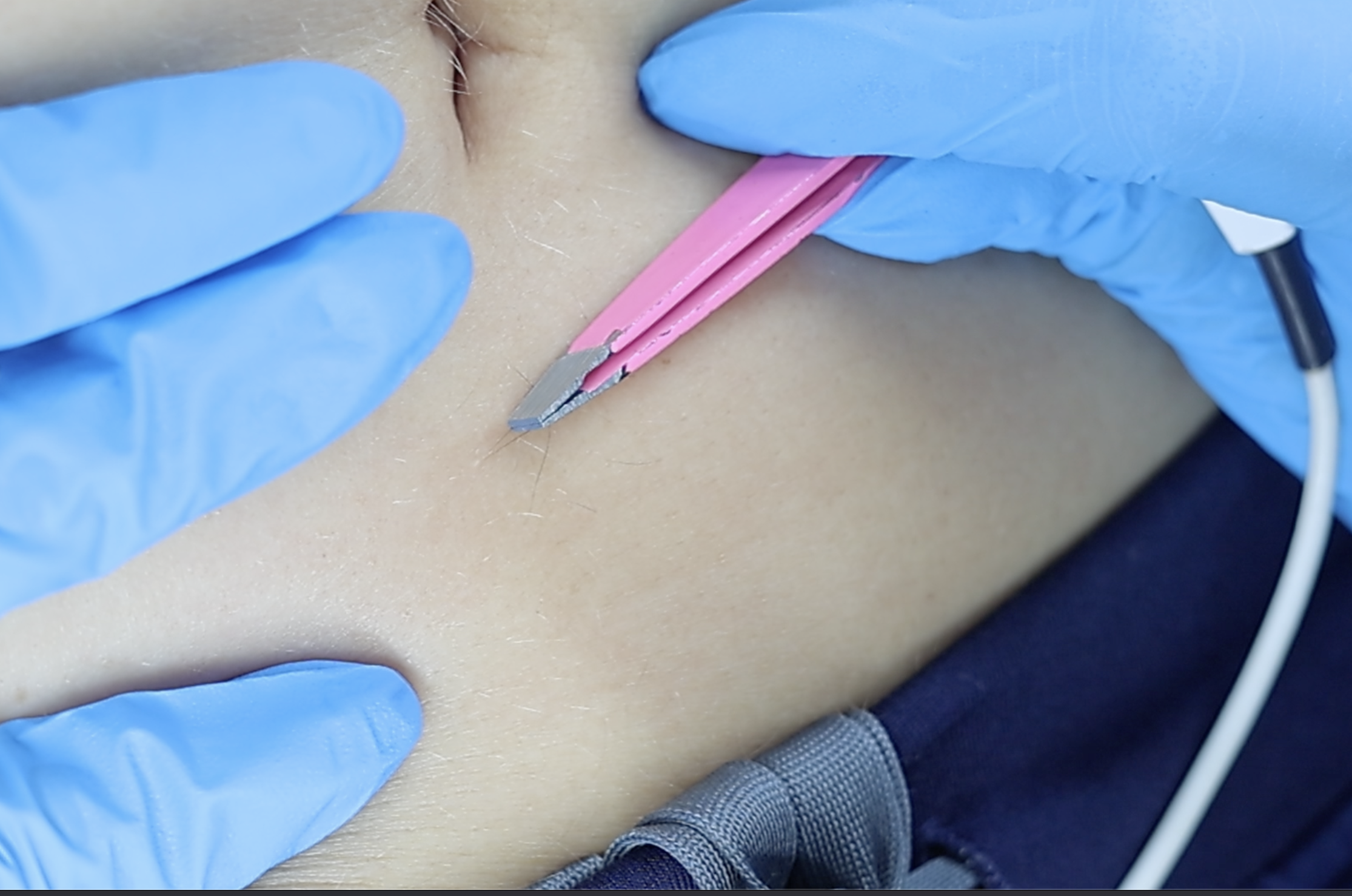 electrolysis hair removal