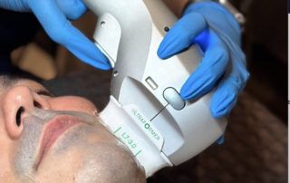 HIFU ultraformer iii