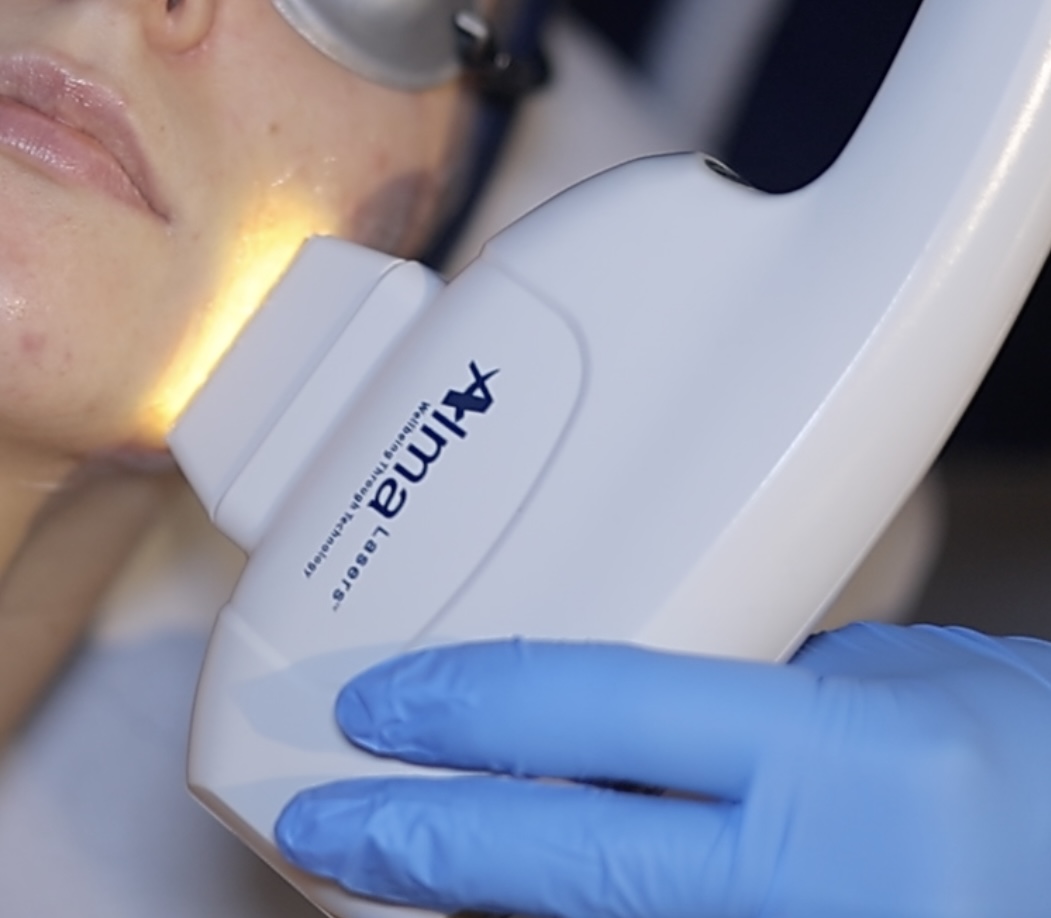 IPL Skin Rejuvenation