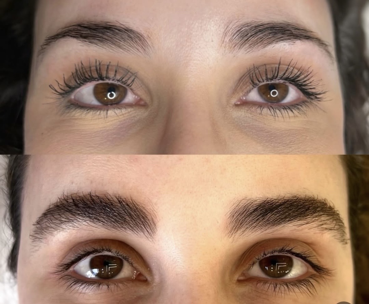 hair exosomes on eyebrows promoting and supporting hair growth using rf microneedling in richmond skin and aesthetics clinic