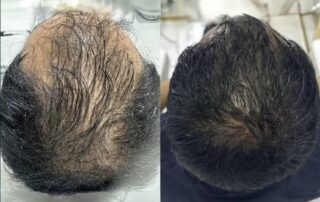 Hair Regeneration using Sylfirm X RF Microneedling plus ASCE exosomes for hair growth