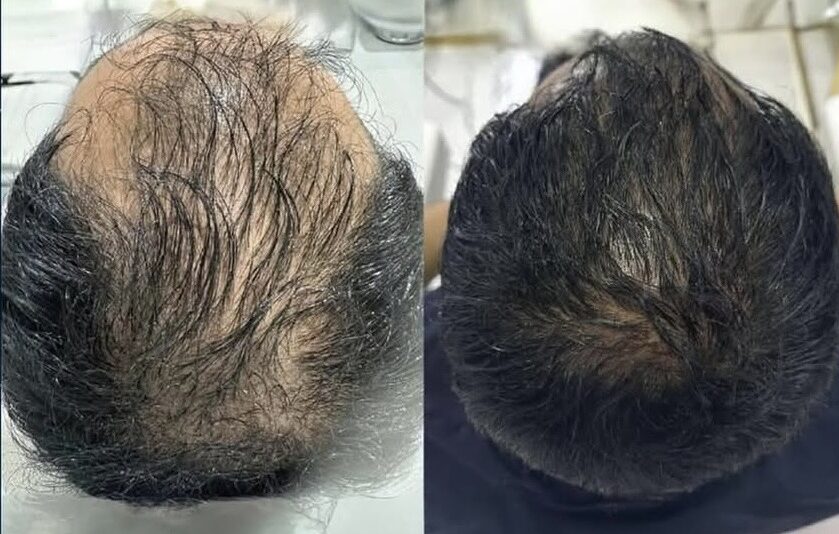 hair exosomes in richmond hills skin and aesthetic clinic - promoting hair growth