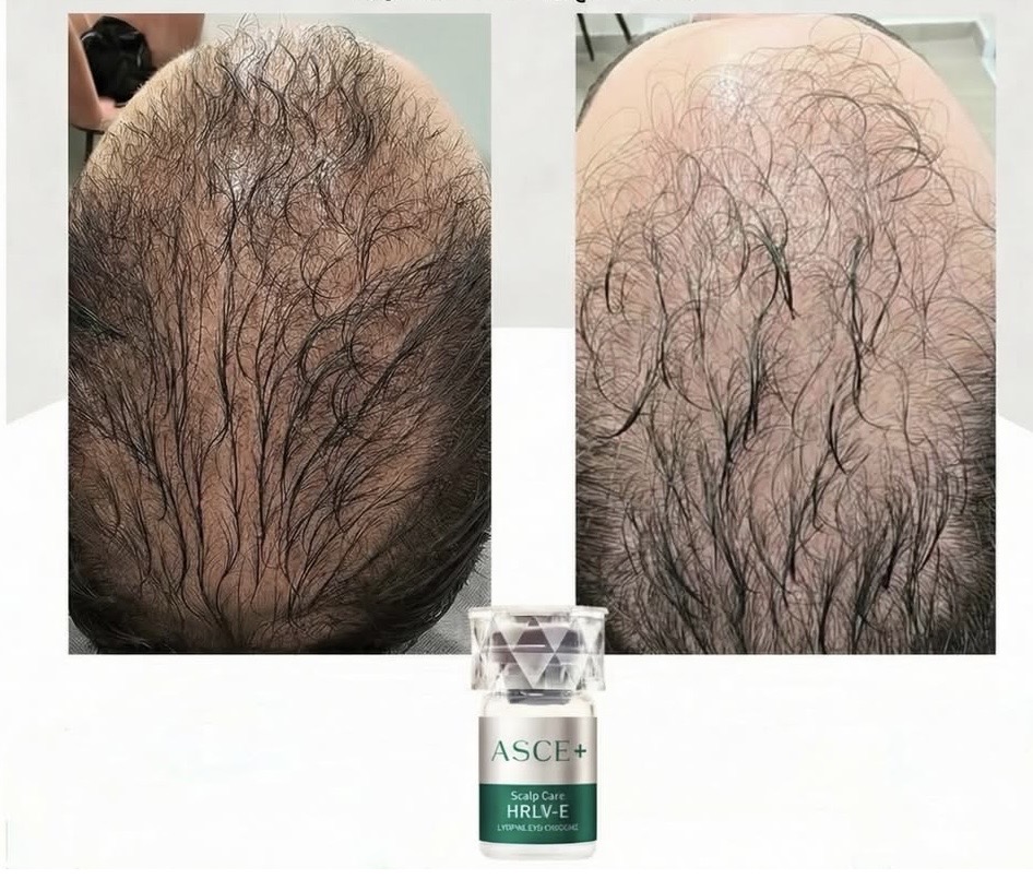 hair exosomes paired with rf microneedling to support and promote hair growth in richmond upon thames skin and aesthetic clinic