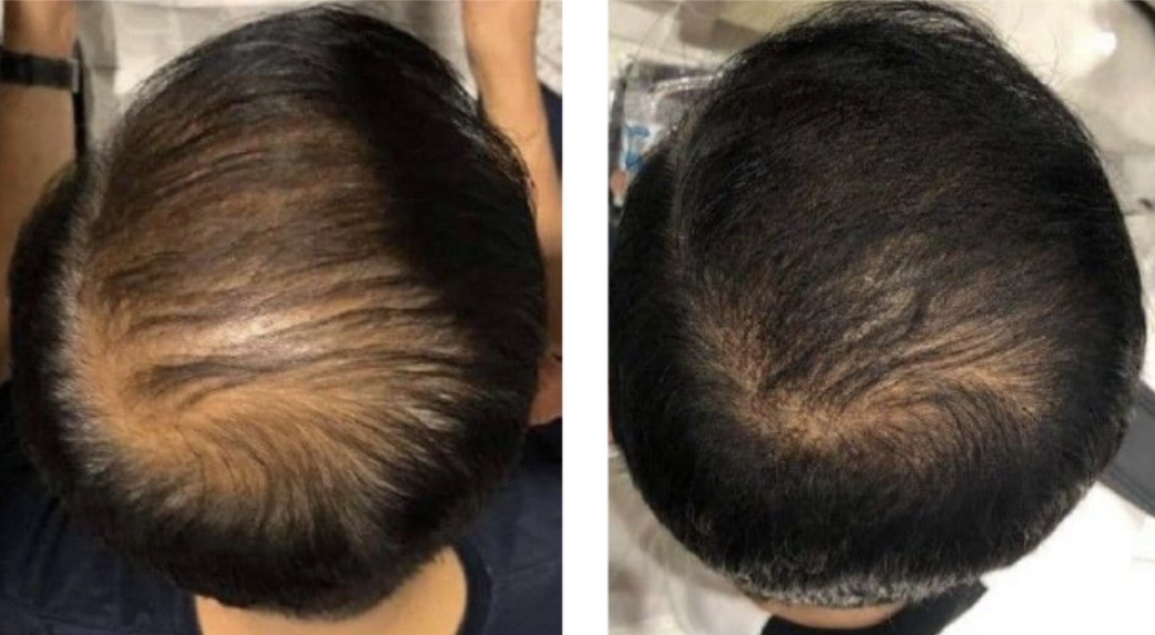 Hair exosomes to promote hair growth for loss of hair