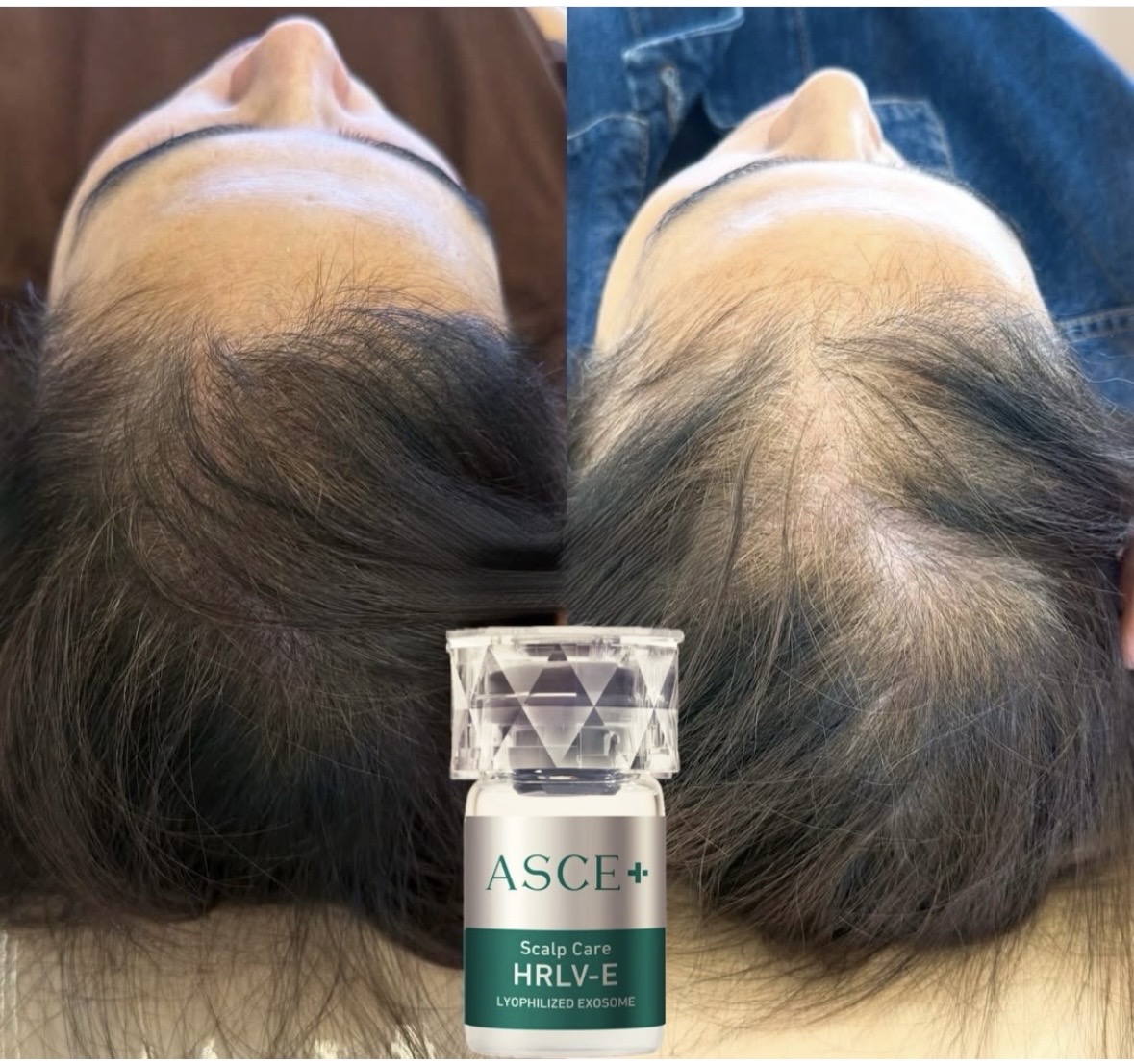 hair exosomes for hair loss, promoting hair growth