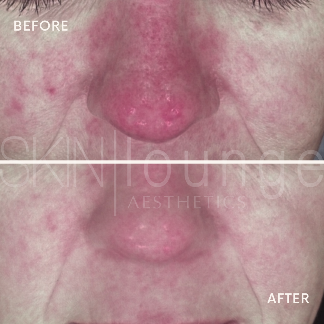 Client at SKIN lounge Aesthetics before and after redness & sensitivity